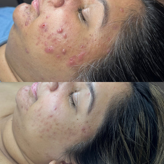 Face Reality Acne Bootcamp - Acne Specialist - Licensed Esthetician in Phoenixville 1