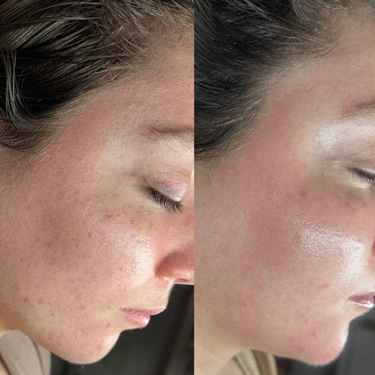 Face Reality Acne Bootcamp - Acne Specialist - Licensed Esthetician in Phoenixville 6