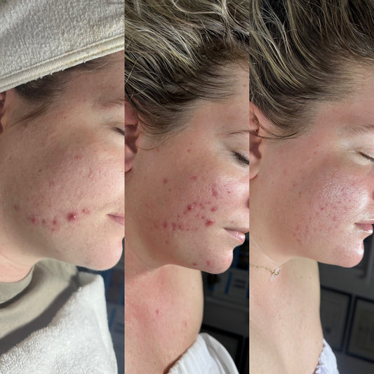 Face Reality Acne Bootcamp - Acne Specialist - Licensed Esthetician in Phoenixville 4