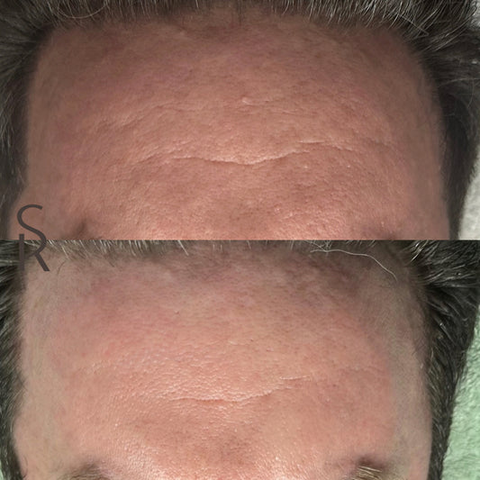 Procell Microchanneling 2