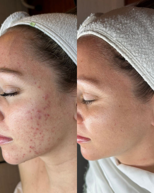 Face Reality Acne Bootcamp - Acne Specialist - Licensed Esthetician in Phoenixville 2